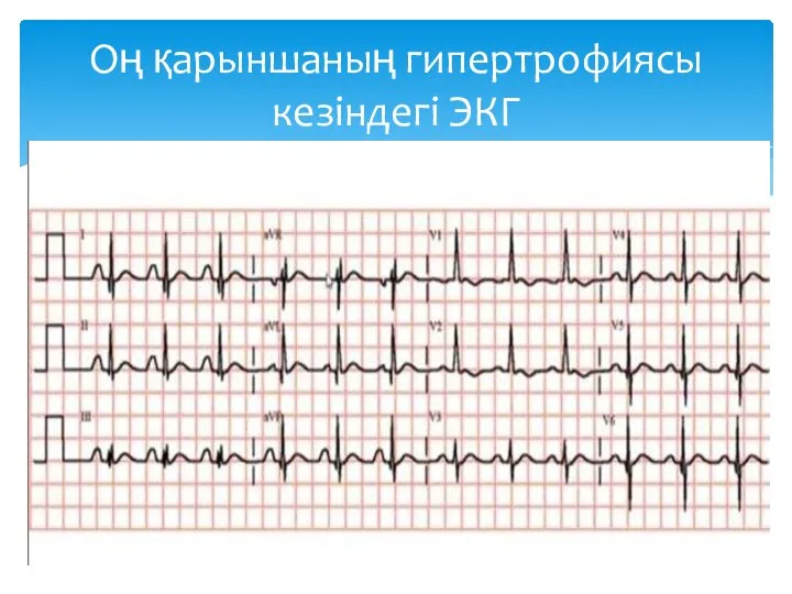 Оң қарыншаның гипертрофиясы кезіндегі ЭКГ