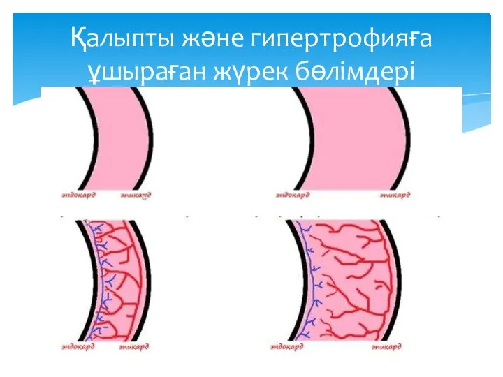 Қалыпты және гипертрофияға ұшыраған жүрек бөлімдері