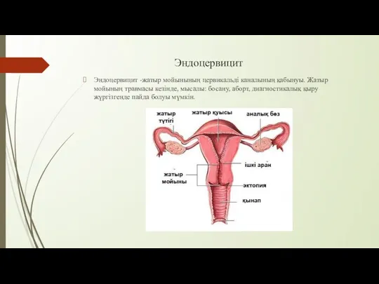 Эндоцервицит Эндоцервицит -жатыр мойынының цервикальді каналының қабынуы. Жатыр мойының травмасы кезінде,