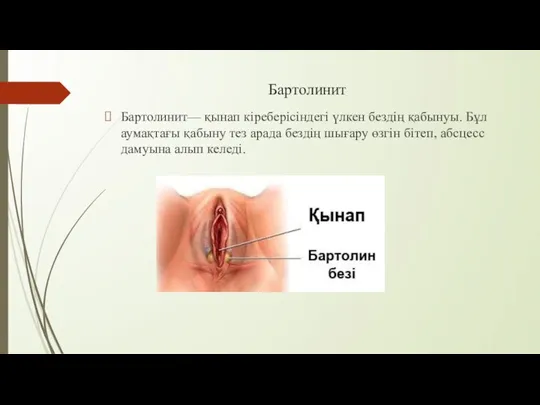 Бартолинит Бартолинит— қынап кіреберісіндегі үлкен бездің қабынуы. Бұл аумақтағы қабыну тез