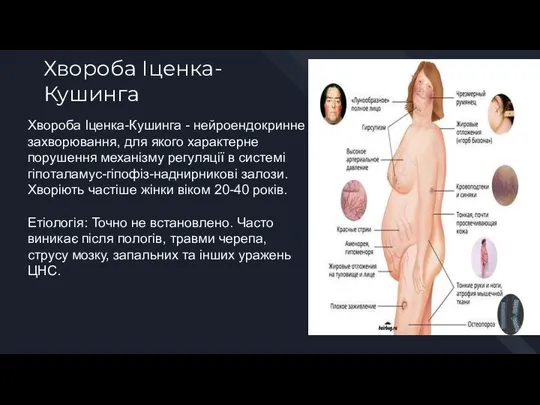 Хвороба Іценка-Кушинга Хвороба Іценка-Кушинга - нейроендокринне захворювання, для якого характерне порушення