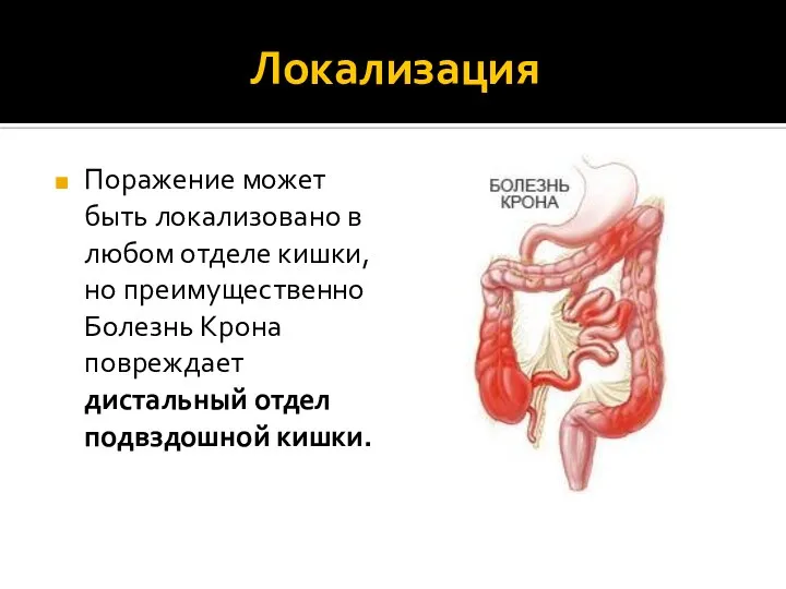 Локализация Поражение может быть локализовано в любом отделе кишки, но преимущественно