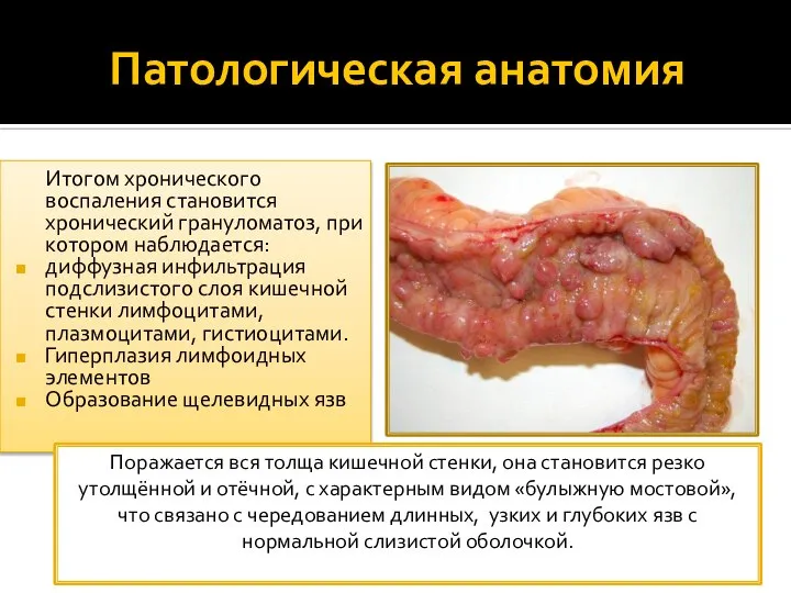 Патологическая анатомия Итогом хронического воспаления становится хронический грануломатоз, при котором наблюдается: