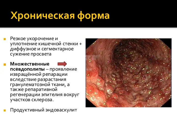 Хроническая форма Резкое укорочение и уплотнение кишечной стенки + диффузное и