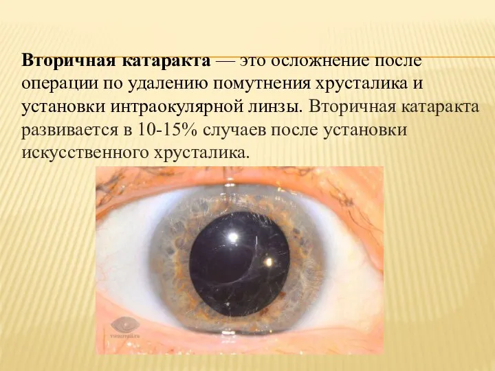 Вторичная катаракта –– это осложнение после операции по удалению помутнения хрусталика