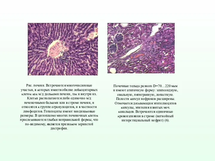 Рис. печени. Встречаются многочисленные участки, в которых имеетя обилие лейкоцитарных клеток