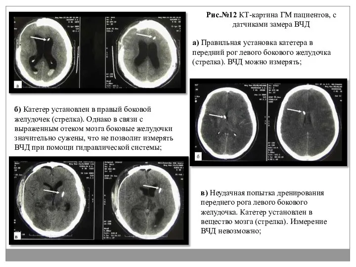 а) Правильная установка катетера в передний рог левого бокового желудочка (стрелка).