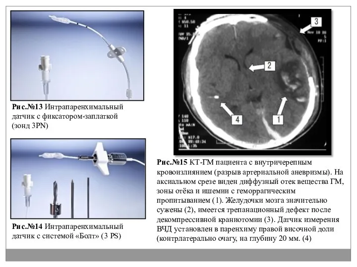 Рис.№13 Интрапаренхимальный датчик с фиксатором-заплаткой (зонд 3PN) Рис.№14 Интрапаренхимальный датчик с