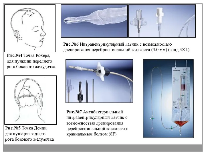 Рис.№4 Точка Кохера, для пункции переднего рога бокового желудочка Рис.№5 Точка