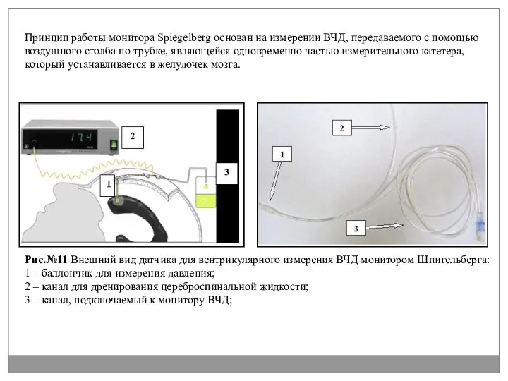 Принцип работы монитора Spiegelberg основан на измерении ВЧД, передаваемого с помощью