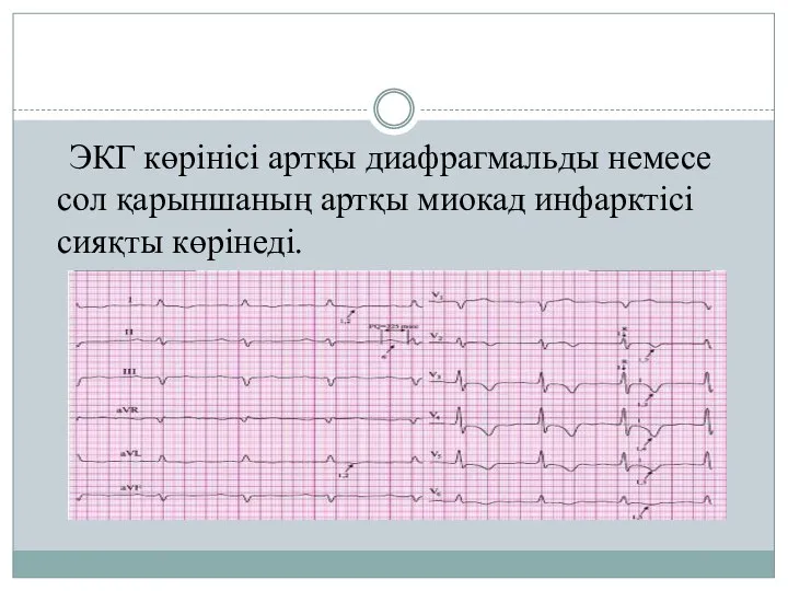 ЭКГ көрінісі артқы диафрагмальды немесе сол қарыншаның артқы миокад инфарктісі сияқты көрінеді.