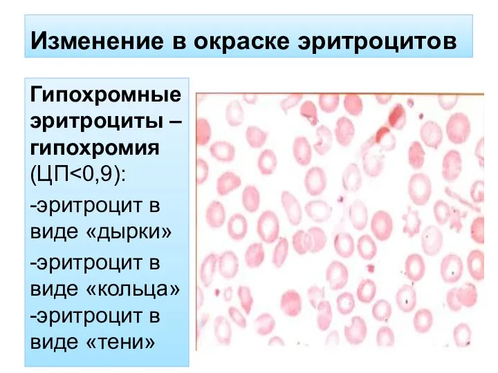 Изменение в окраске эритроцитов Гипохромные эритроциты – гипохромия (ЦП˂0,9): -эритроцит в