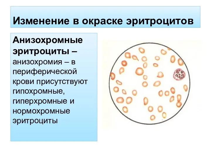 Изменение в окраске эритроцитов Анизохромные эритроциты – анизохромия – в периферической