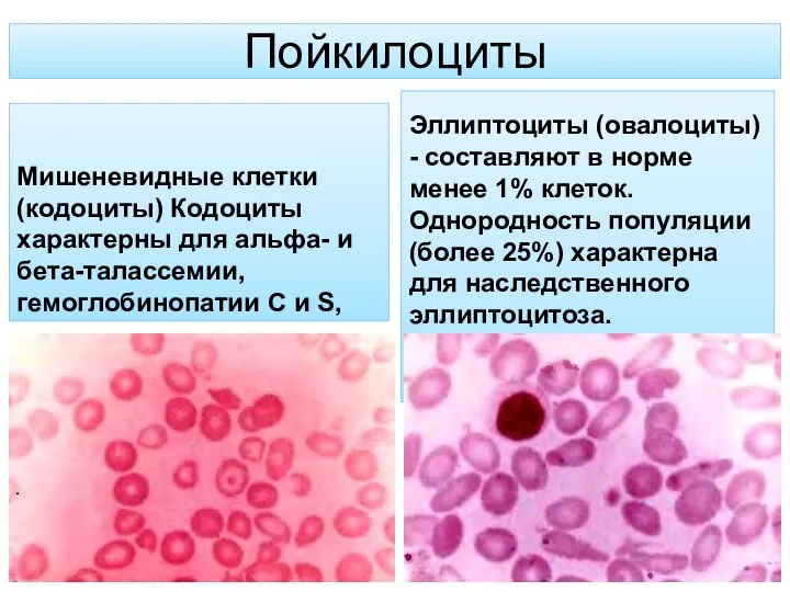 Пойкилоциты Мишеневидные клетки (кодоциты) Кодоциты характерны для альфа- и бета-талассемии, гемоглобинопатии