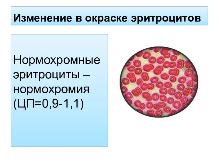 Изменение в окраске эритроцитов Нормохромные эритроциты – нормохромия (ЦП=0,9-1,1)