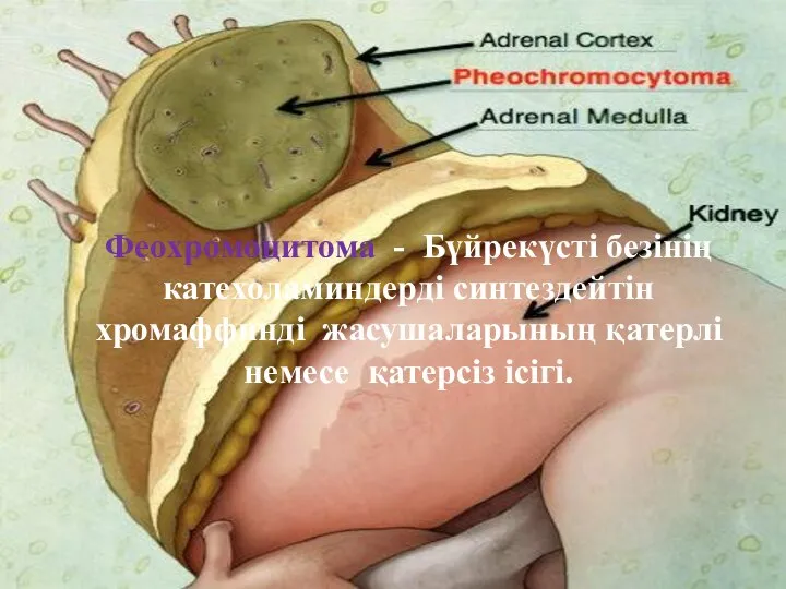 Феохромоцитома - Бүйрекүсті безінің катехоламиндерді синтездейтін хромаффинді жасушаларының қатерлі немесе қатерсіз ісігі.