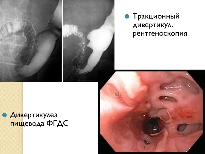 Дивертикулез пищевода ФГДС Тракционный дивертикул. рентгеноскопия