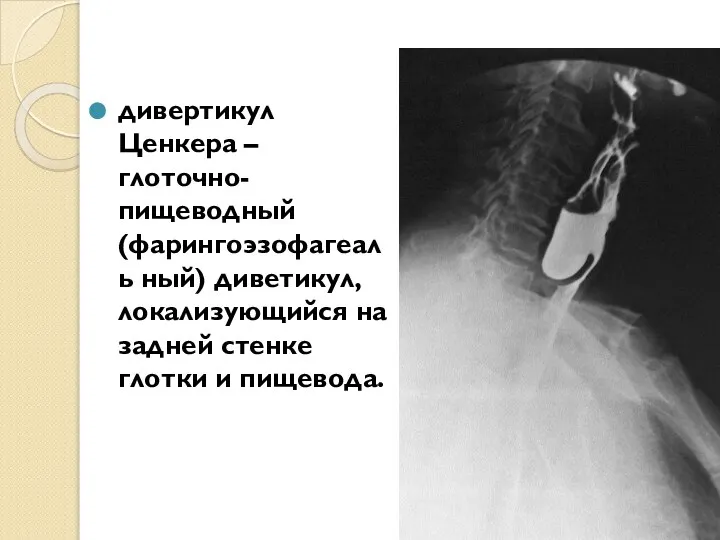 дивертикул Ценкера – глоточно-пищеводный (фарингоэзофагеаль ный) диветикул, локализующийся на задней стенке глотки и пищевода.