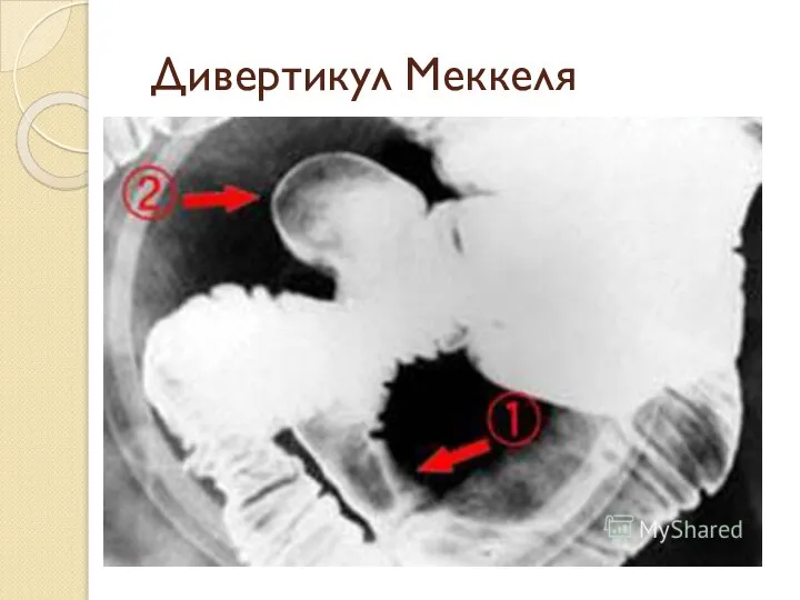 Дивертикул Меккеля