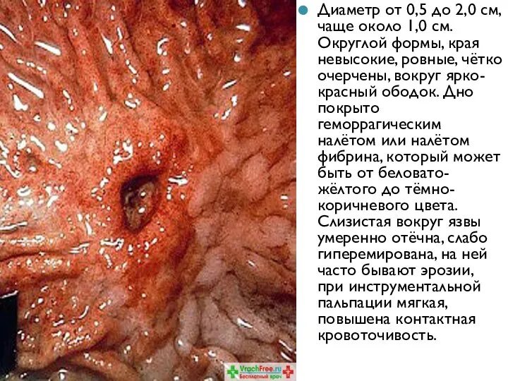 Диаметр от 0,5 до 2,0 см, чаще около 1,0 см. Округлой