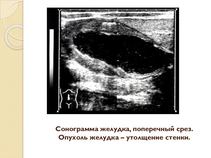 Сонограмма желудка, поперечный срез. Опухоль желудка – утолщение стенки.