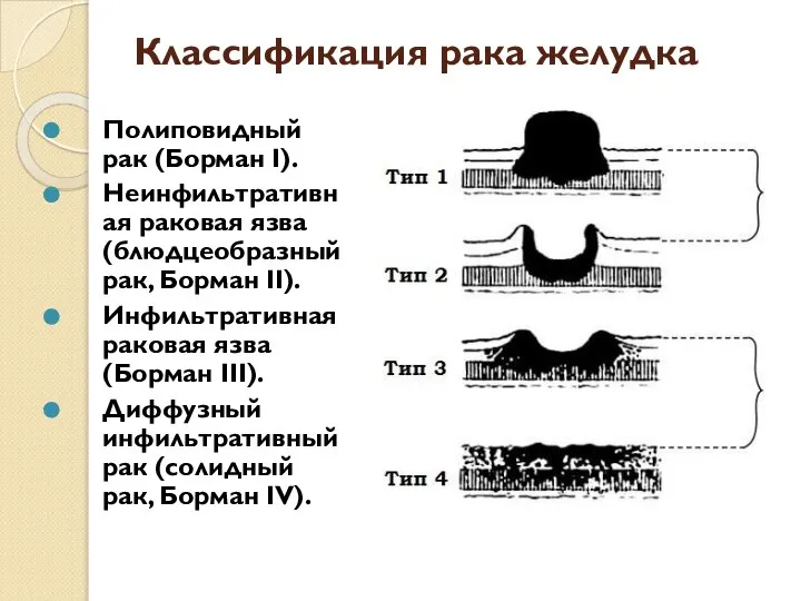 Классификация рака желудка Полиповидный рак (Борман I). Неинфильтративная раковая язва (блюдцеобразный