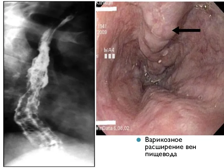 Варикозное расширение вен пищевода
