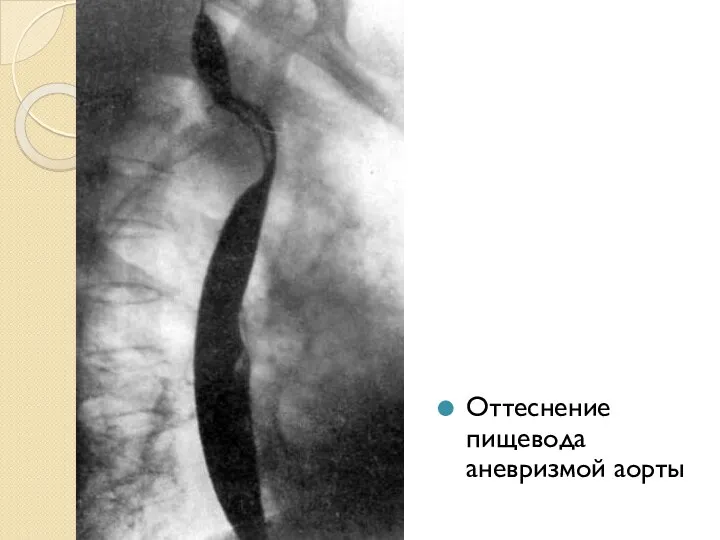 Оттеснение пищевода аневризмой аорты