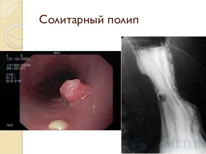 Солитарный полип