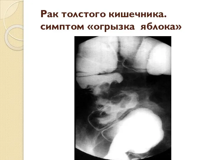 Рак толстого кишечника. симптом «огрызка яблока»