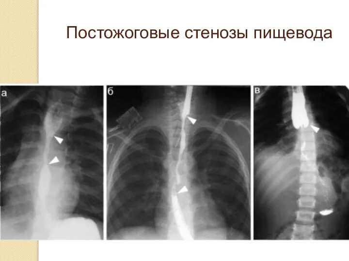 Постожоговые стенозы пищевода