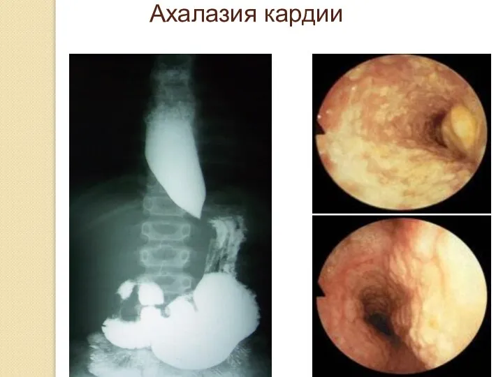 Ахалазия кардии