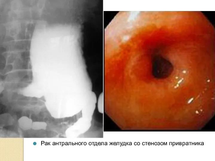 Рак антрального отдела желудка со стенозом привратника
