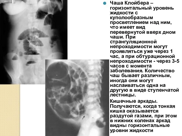 Чаша Клойбера – горизонтальный уровень жидкости с куполообразным просветлением над ним,