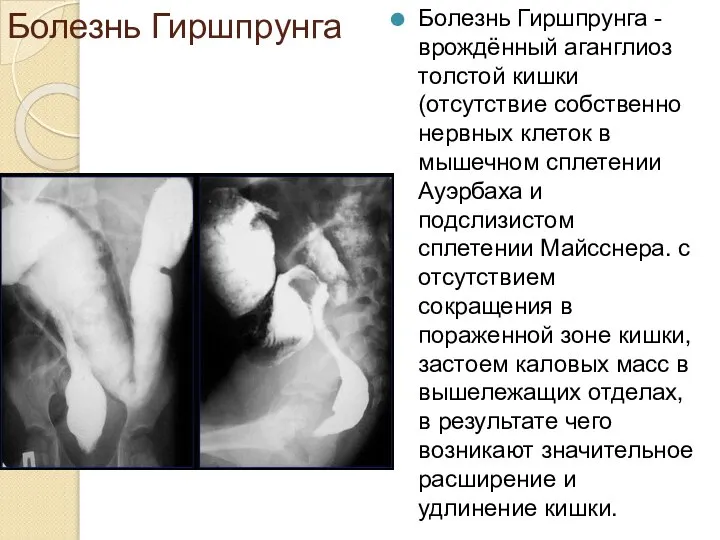 Болезнь Гиршпрунга Болезнь Гиршпрунга - врождённый аганглиоз толстой кишки (отсутствие собственно