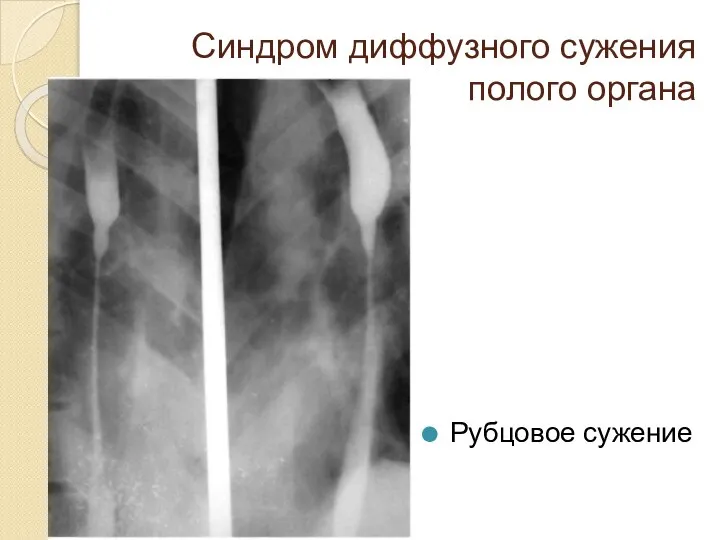 Синдром диффузного сужения полого органа Рубцовое сужение