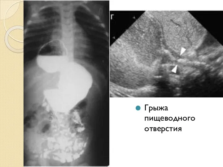 Грыжа пищеводного отверстия