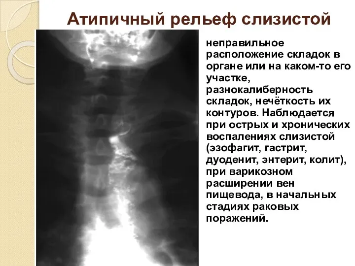 Атипичный рельеф слизистой неправильное расположение складок в органе или на каком-то