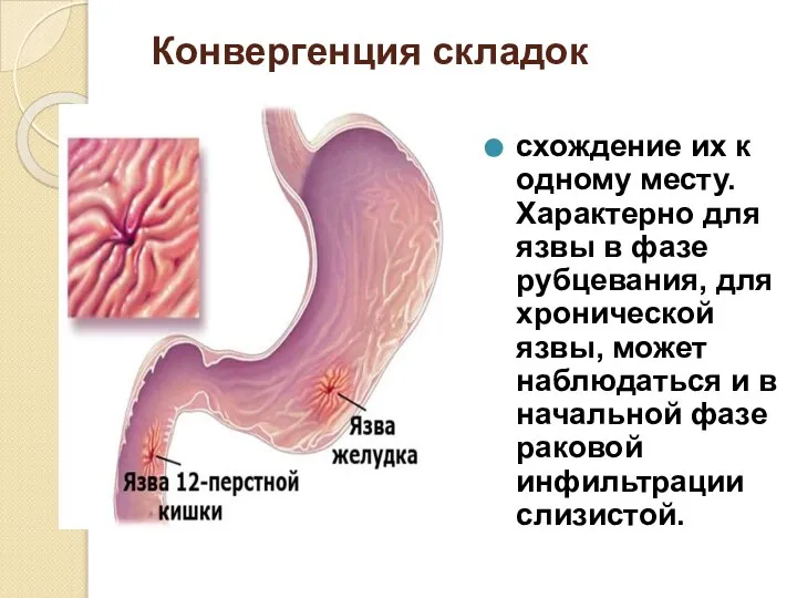 Конвергенция складок схождение их к одному месту. Характерно для язвы в