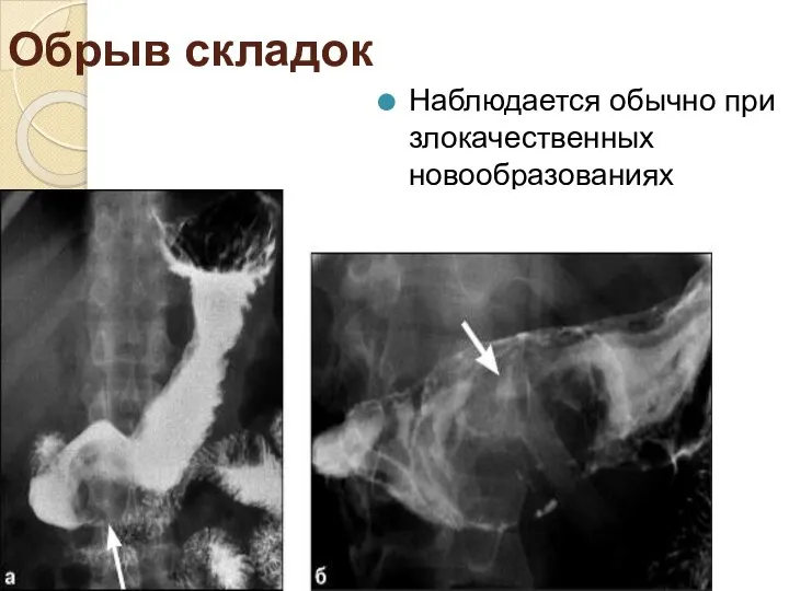 Обрыв складок Наблюдается обычно при злокачественных новообразованиях