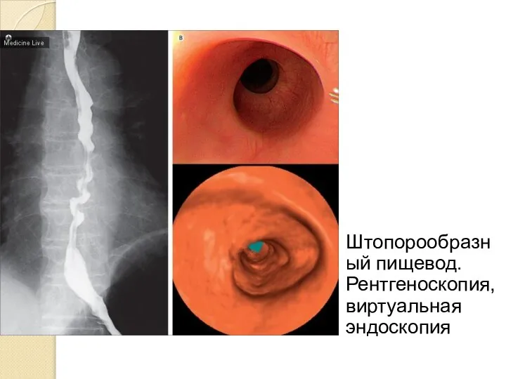 Штопорообразный пищевод. Рентгеноскопия, виртуальная эндоскопия