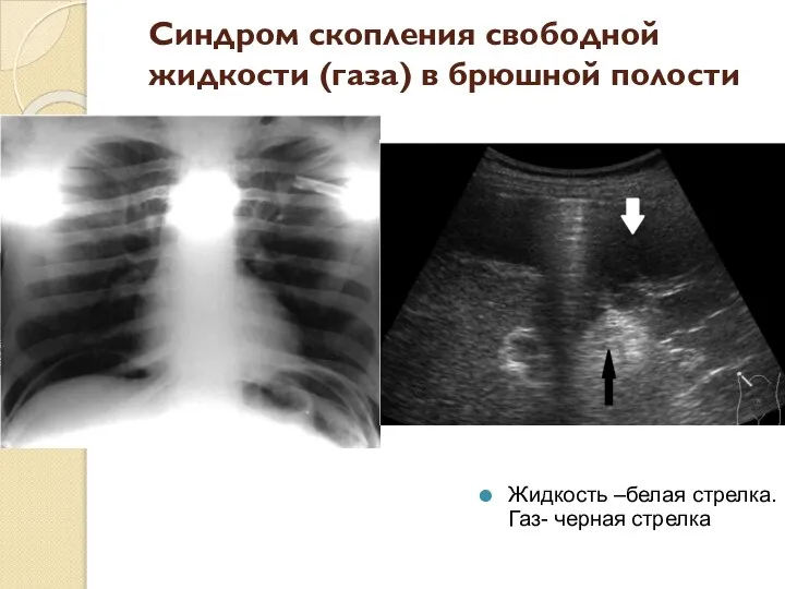Синдром скопления свободной жидкости (газа) в брюшной полости Жидкость –белая стрелка. Газ- черная стрелка