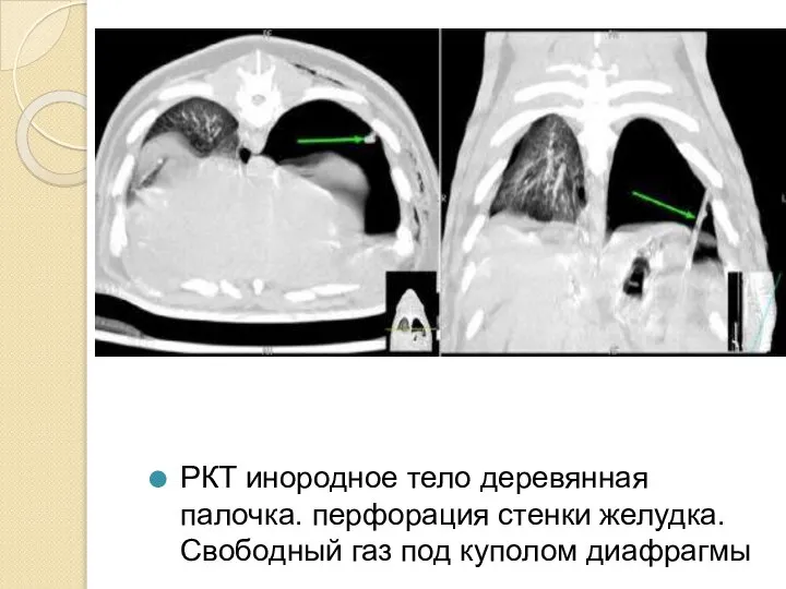 РКТ инородное тело деревянная палочка. перфорация стенки желудка. Свободный газ под куполом диафрагмы