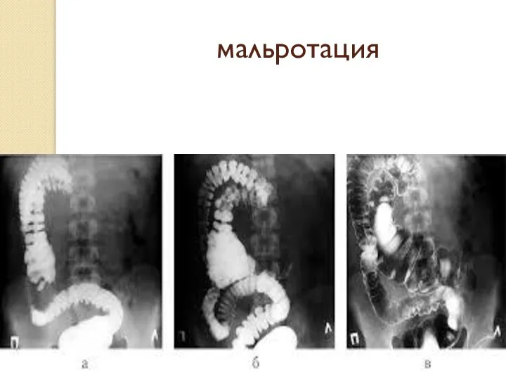 мальротация