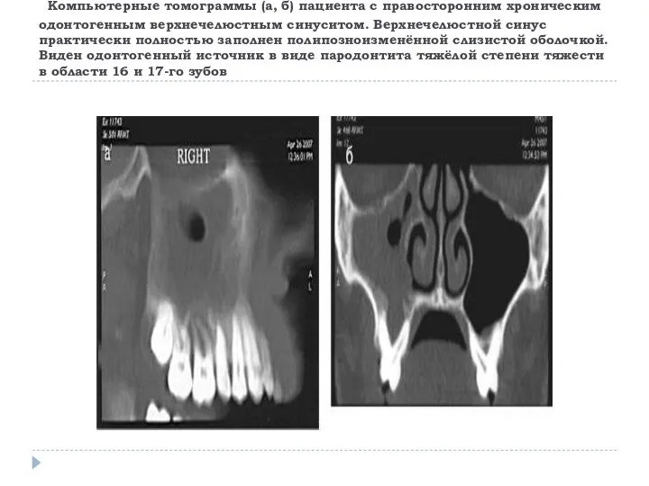 Компьютерные томограммы (а, б) пациента с правосторонним хроническим одонтогенным верхнечелюстным синуситом.