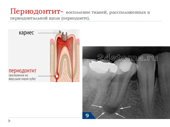 Периодонтит- восполение тканей, рассположенных в периодонтальной щели (периодонте).