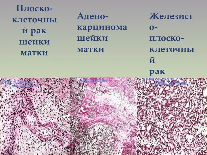 Плоско-клеточный рак шейки матки Адено-карцинома шейки матки Железисто- плоско- клеточный рак шейки матки