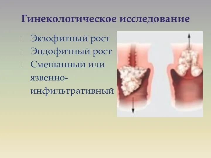 Гинекологическое исследование Экзофитный рост Эндофитный рост Смешанный или язвенно- инфильтративный