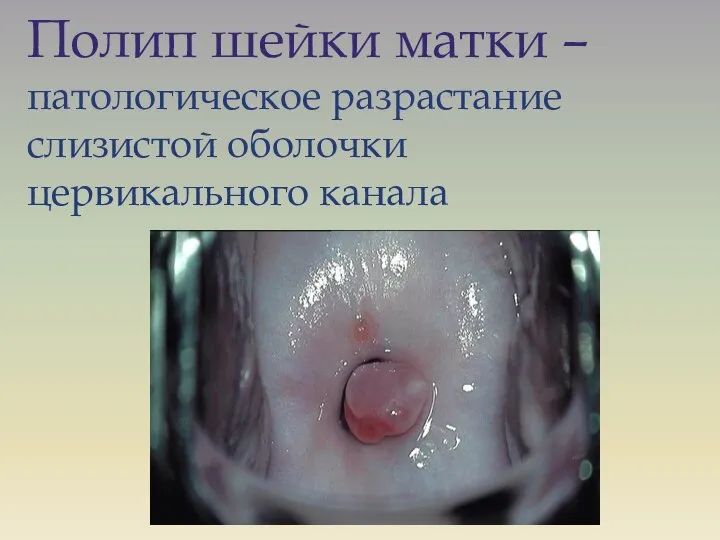 Полип шейки матки – патологическое разрастание слизистой оболочки цервикального канала