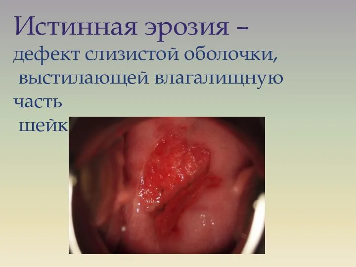 Истинная эрозия – дефект слизистой оболочки, выстилающей влагалищную часть шейки матки